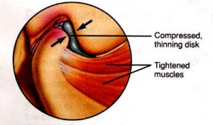 TMJ Treatment