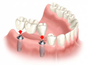 multiple_implants1